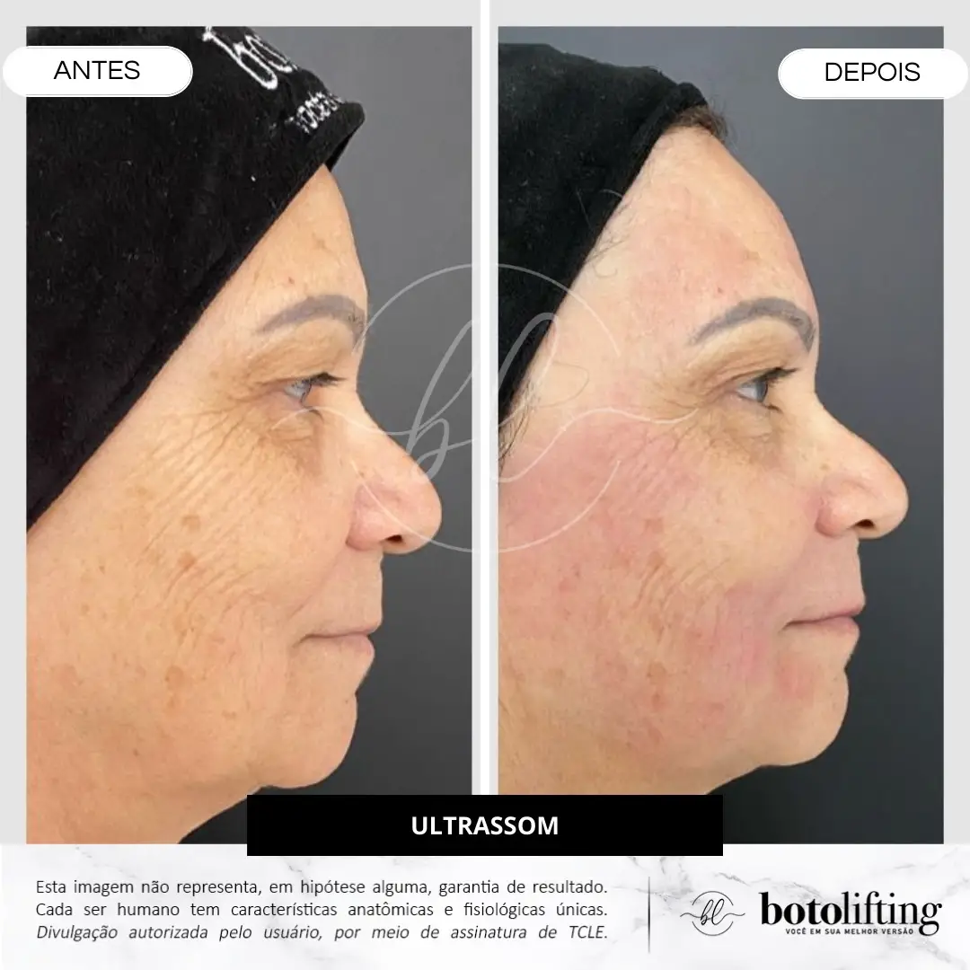Antes e depois — Ultrassom