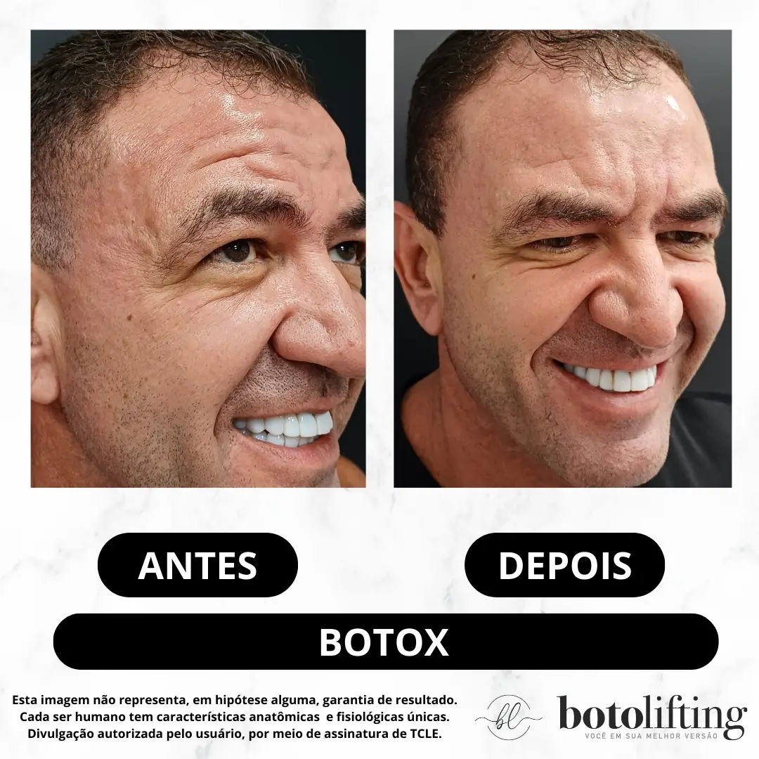 Antes e depois — Toxina Botulínica