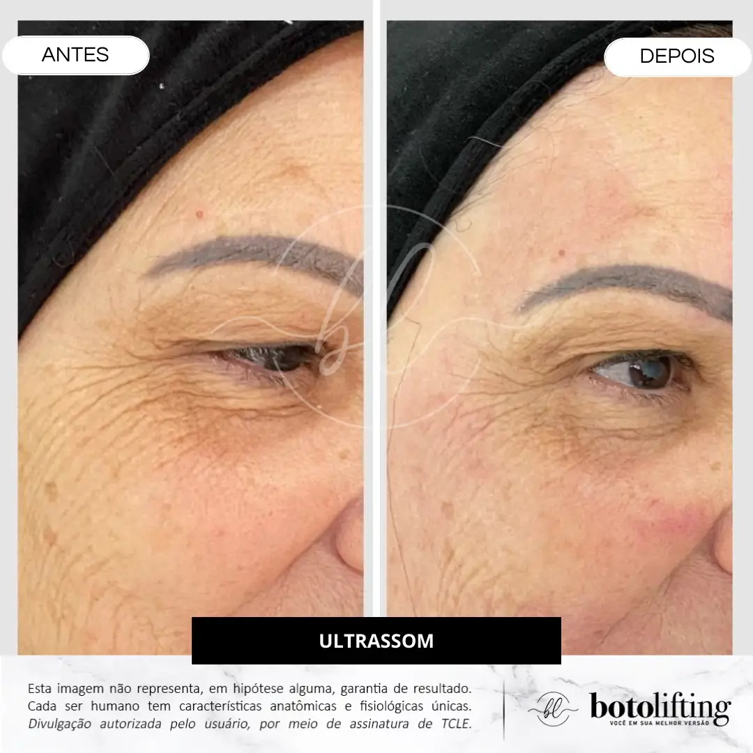 Antes e depois — Ultrassom