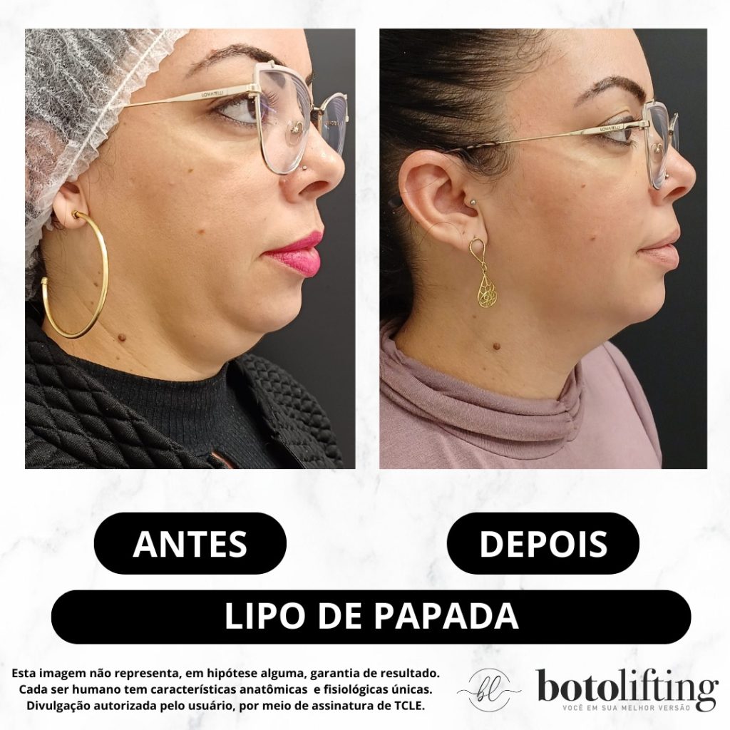 Botolifting Praia Grande Clínica de Estética Facial e Corporal