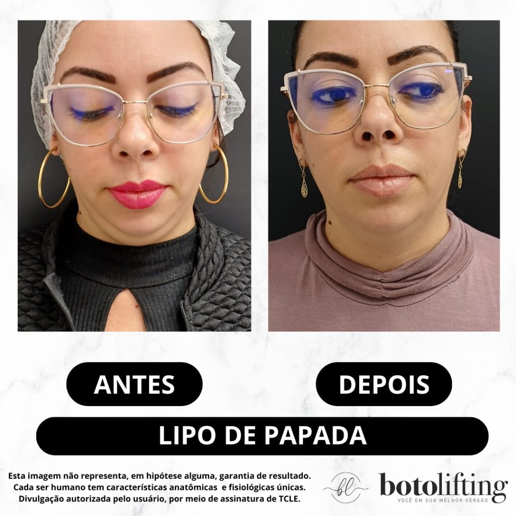 Botolifting Praia Grande Clínica de Estética Facial e Corporal