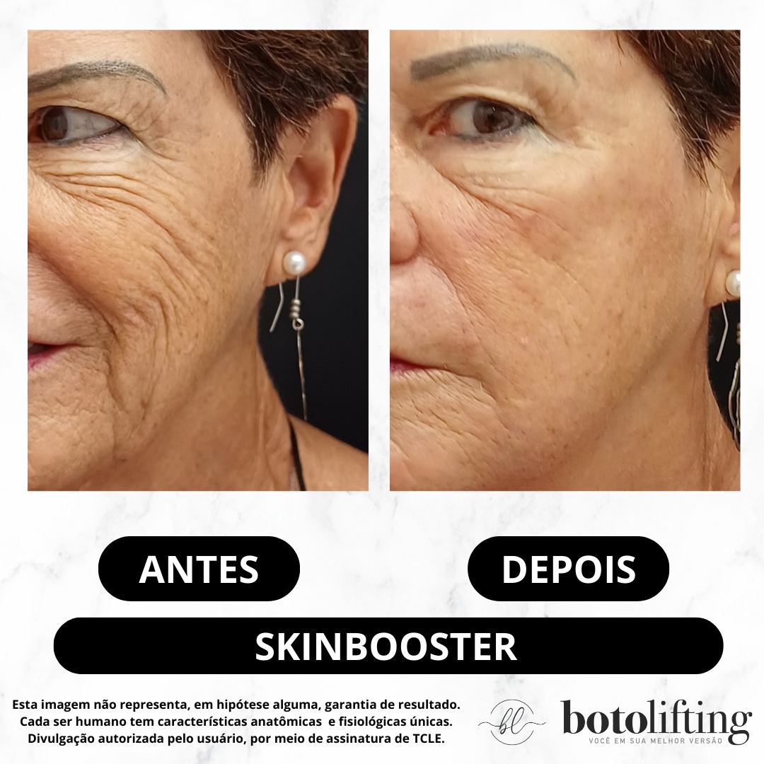 Botolifting Praia Grande Clínica de Estética Facial e Corporal