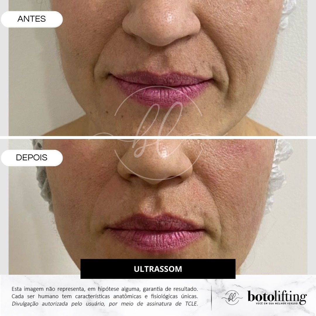 Botolifting Praia Grande Clínica de Estética Facial e Corporal