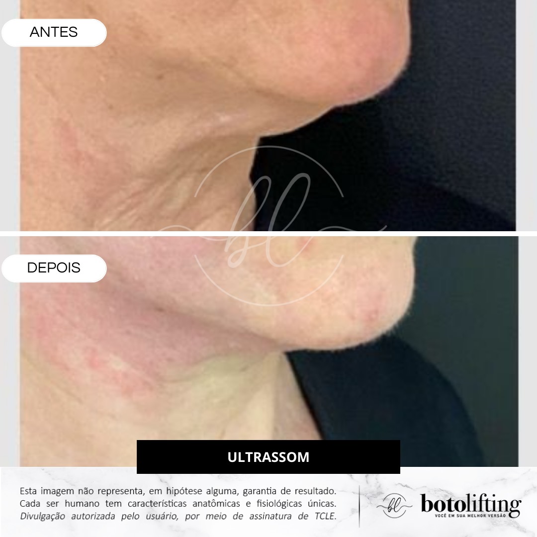 Botolifting Praia Grande Clínica de Estética Facial e Corporal