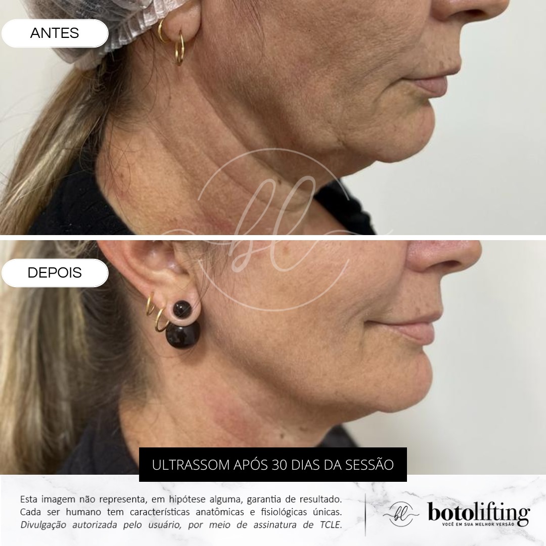 Botolifting Praia Grande Clínica de Estética Facial e Corporal